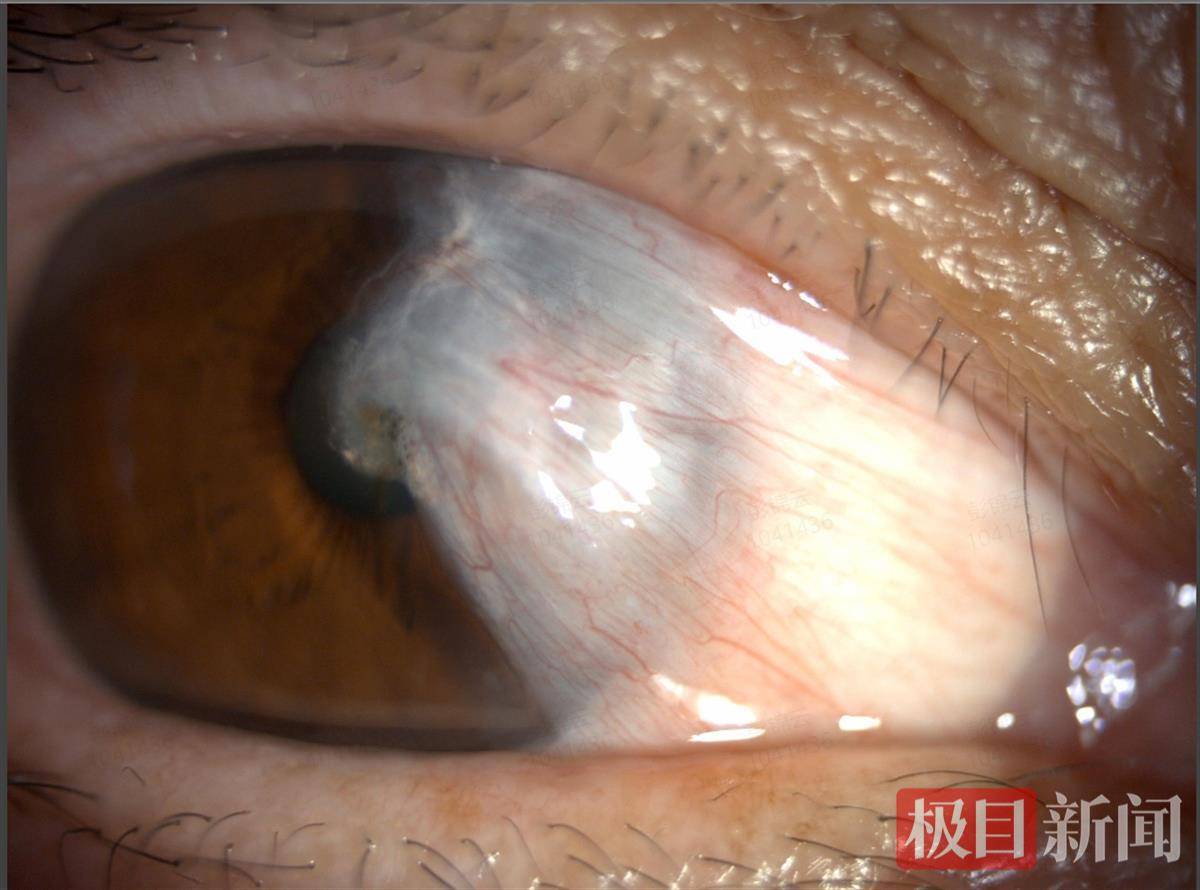 眼球缺失盲人办卡被要求睁眼认证