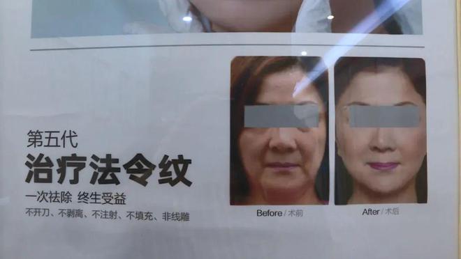 男子花17万屁股整形后肛门功能受损