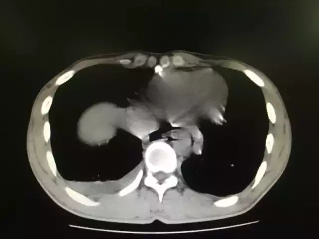 男子吃饭狼吞虎咽把食管吃破了