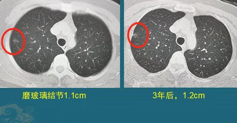 震惊！27岁女子肺结节没在意 1年后确诊肺癌，医生痛心疾首这些信号别忽视！